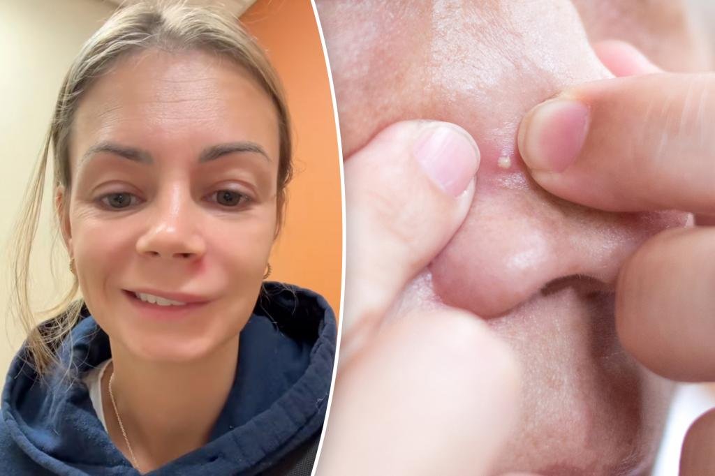 I popped a pimple in the ‘triangle of death’ and ended up in urgent care on 4 prescription drugs I popped a pimple in the ‘triangle of death’ and ended up in urgent care on 4 prescription drugs