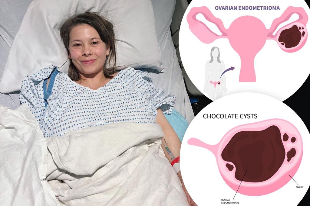 What is a chocolate cyst? The growth Bindi Irwin had removed — along with 51 lesions and her appendix What is a chocolate cyst? The growth Bindi Irwin had removed — along with 51 lesions and her appendix