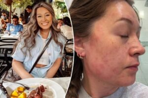 Exclusive | I’m a vegan against my will after developing an overnight allergy that’s increasing across the US Exclusive | I’m a vegan against my will after developing an overnight allergy that’s increasing across the US