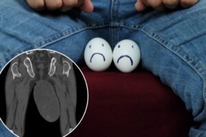 Tumor the size of a chicken egg found in man’s scrotum — due to rare condition usually found in vaginas Tumor the size of a chicken egg found in man’s scrotum — due to rare condition usually found in vaginas