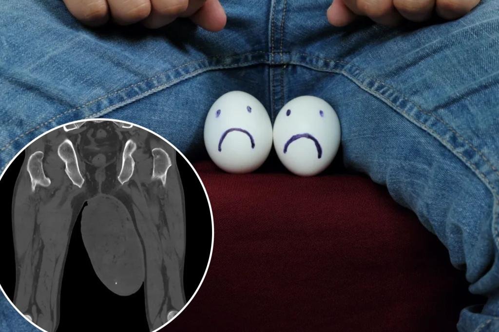 Tumor the size of a chicken egg found in man’s scrotum — due to rare condition usually found in vaginas Tumor the size of a chicken egg found in man’s scrotum — due to rare condition usually found in vaginas