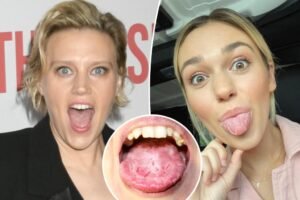What is ‘geographic tongue’? All about ‘SNL’ star Kate McKinnon’s ‘gross’ condition What is ‘geographic tongue’? All about ‘SNL’ star Kate McKinnon’s ‘gross’ condition