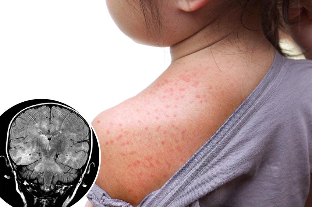 This deadly brain disorder can develop a decade after you get the measles — and it just killed a child This deadly brain disorder can develop a decade after you get the measles — and it just killed a child