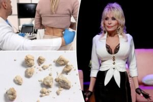 6 signs of kidney stones as Dolly Parton cancels event because one was giving her ‘a lot of problems’