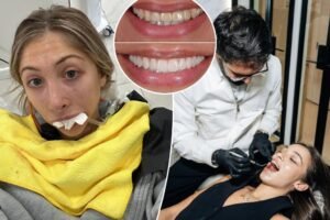 Exclusive | Celebs made veneers a popular post-pandemic cosmetic quick fix — but regret is on the rise: ‘My mouth is permanently screwed up’ Exclusive | Celebs made veneers a popular post-pandemic cosmetic quick fix — but regret is on the rise: ‘My mouth is permanently screwed up’
