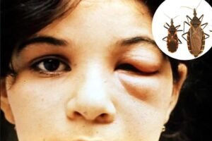 Deadly ‘kissing bug’ parasite is now in 32 US states — and you might not even know you have it Deadly ‘kissing bug’ parasite is now in 32 US states — and you might not even know you have it