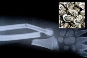 Chinese-made ‘bone glue’ fixes fractures in just 3 minutes with one injection: report
