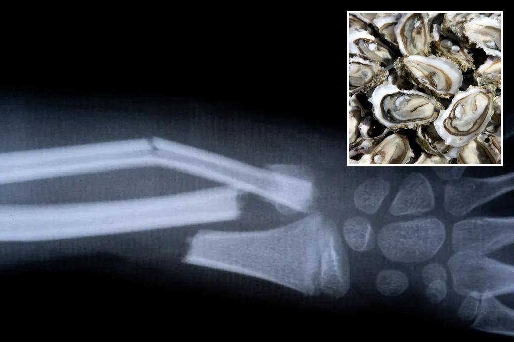Chinese-made ‘bone glue’ fixes fractures in just 3 minutes with one injection: report Chinese-made ‘bone glue’ fixes fractures in just 3 minutes with one injection: report