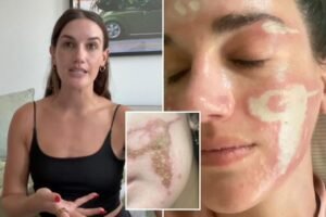 My session with a celebrity aesthetician left me burned, scarred and irreparably damaged My session with a celebrity aesthetician left me burned, scarred and irreparably damaged