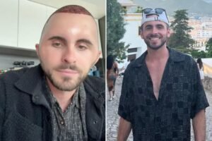 I got a hair transplant at 27 — the shocking side effect that left me looking like a cartoon