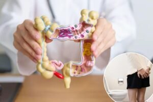 This is the ‘strongest predictor of colorectal cancer’ under 50 — it increases your odds by 850%