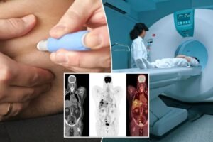 ‘Unusual’ new side effect of drugs like Ozempic becoming ‘increasingly common’